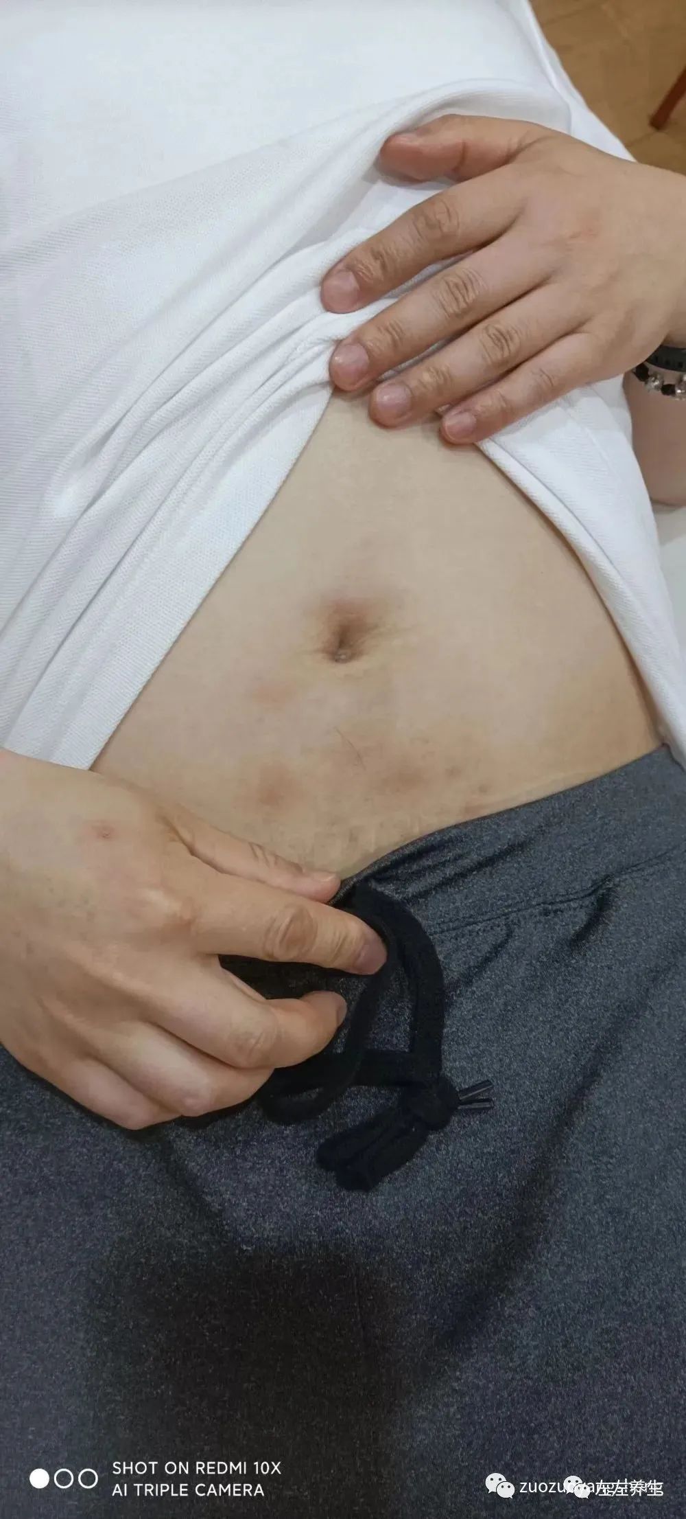 案例分享:腹部奇癢無比濕疹調理案例 案例分享:腹部奇癢無比濕疹調理案例