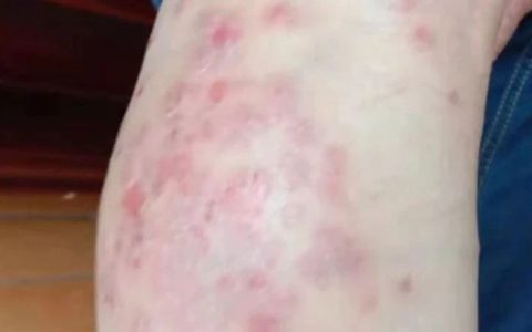 十年牛皮癬6個月基本恢復案例-七不姜 生姜養生網-明德CSA生態姜園&明安農業