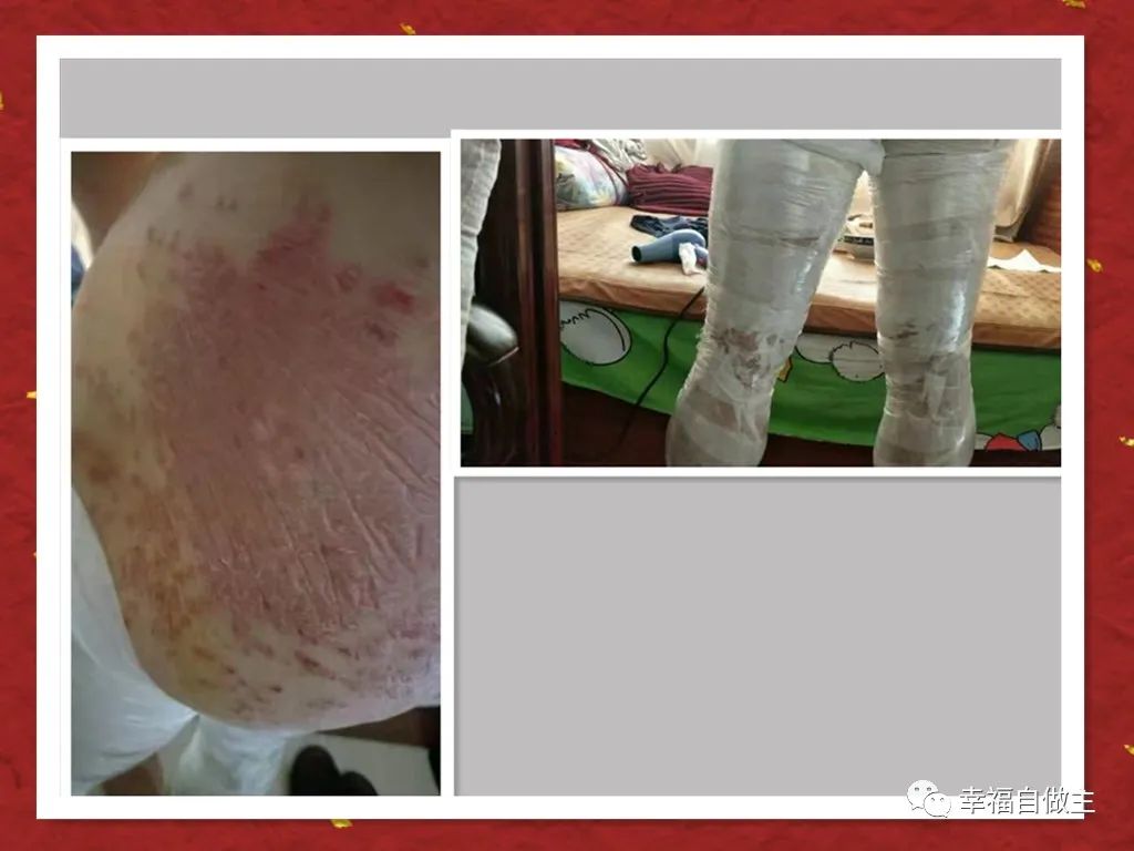 十年牛皮癬6個月基本恢復案例