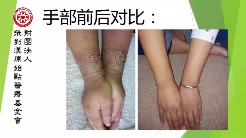 嚴重濕疹案例（青島）2018-1-24-七不姜 生姜養生網-明德CSA生態姜園&明安農業