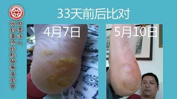 腳后跟雞眼案例-七不姜 生姜養生網-明德CSA生態姜園&明安農業