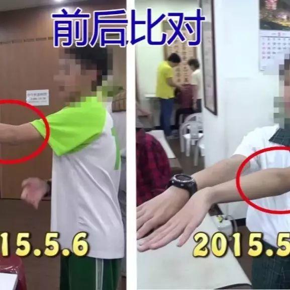 手骨裂21天恢復案例（簡體版）-七不姜 生姜養生網-明德CSA生態姜園&明安農業