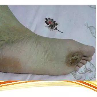 雞眼用原始點處理9天痊愈案例（簡體版）-七不姜 生姜養生網-明德CSA生態姜園&明安農業