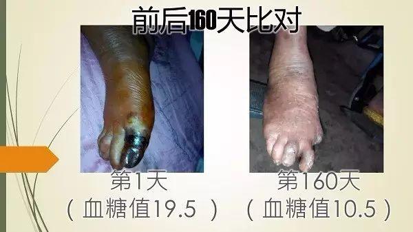 廣西黑腳阿嫲（糖尿病）案例（簡體版）-七不姜 生姜養生網-明德CSA生態姜園&明安農業