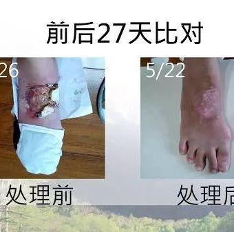 腳部燙傷案例（熱湯）（簡體版）-七不姜 生姜養生網-明德CSA生態姜園&明安農業