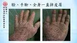牛皮癬案例(日本人)(簡體版)-七不姜 生姜養生網-明德CSA生態姜園&明安農業