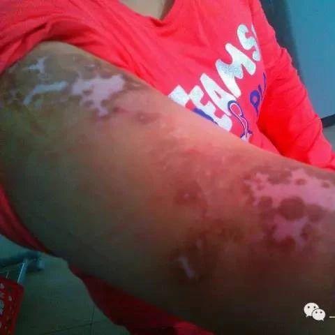 原始點治療白癜風案例-七不姜 生姜養生網-明德CSA生態姜園&明安農業