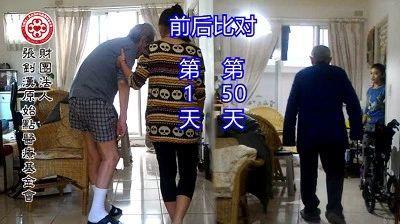 溫敷過度燙傷案例-七不姜 生姜養生網-明德CSA生態姜園&明安農業
