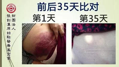 腹部腫脹案例-七不姜 生姜養生網-明德CSA生態姜園&明安農業