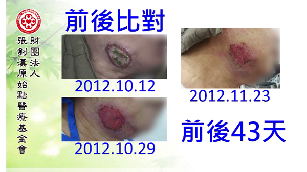 干癬案例（血燥李先生）（簡體版）
