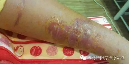 案例分享：原始點調理蛇毒的成功案例-七不姜 生姜養生網-明德CSA生態姜園&明安農業