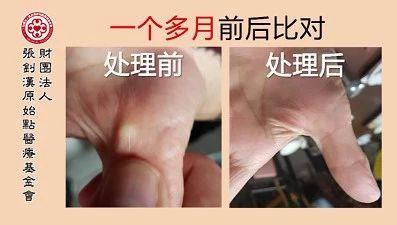 手掌軟骨增生案例-七不姜 生姜養生網-明德CSA生態姜園&明安農業