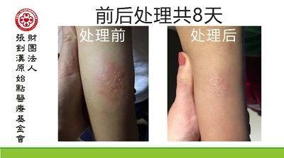 不明生物咬傷案例-七不姜 生姜養生網-明德CSA生態姜園&明安農業