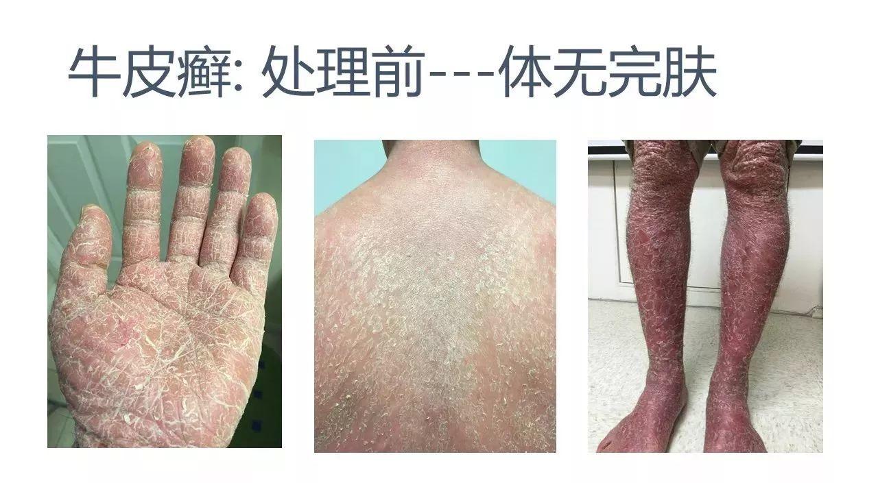 牛皮癬案例（日本人）（后續追蹤）(字幕版)-七不姜 生姜養生網-明德CSA生態姜園&明安農業