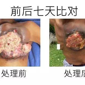 乳癌七天大幅改善案例（46歲辛巴威）（簡體版）-七不姜 生姜養生網-明德CSA生態姜園&明安農業