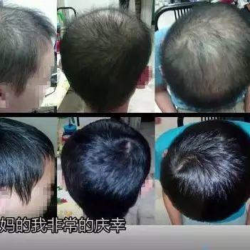 少年脫發案例（馬國）（簡體版）-七不姜 生姜養生網-明德CSA生態姜園&明安農業