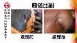 肩部潰爛案例(辛巴威)-七不姜 生姜養生網-明德CSA生態姜園&明安農業