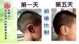 耳傷案例(小孩)-七不姜 生姜養生網-明德CSA生態姜園&明安農業
