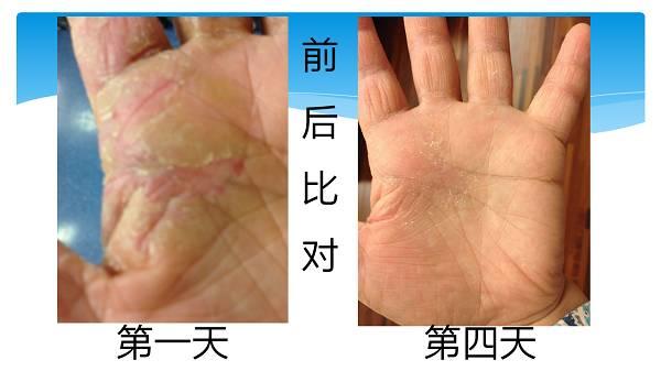 干手癥24小時溫敷4天痊愈（簡體版）-七不姜 生姜養生網-明德CSA生態姜園&明安農業