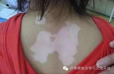 原始點案例：白癜風