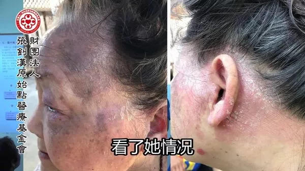 牛皮癬案例（美國）-七不姜 生姜養生網-明德CSA生態姜園&明安農業