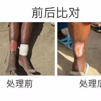 腳部皮膚癌案例（辛巴威探訪）（簡體版）-七不姜 生姜養生網-明德CSA生態姜園&明安農業