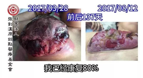 乳癌案例(馬來西亞)--2017.11最新案例-七不姜 生姜養生網-明德CSA生態姜園&明安農業