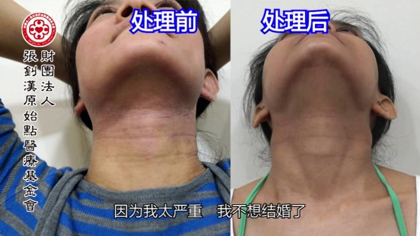 異位性皮膚炎案例(王小姐)（簡體版）-2017.8最新案例