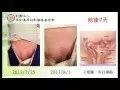 腹股溝小腸疝氣案例-七不姜 生姜養生網-明德CSA生態姜園&明安農業