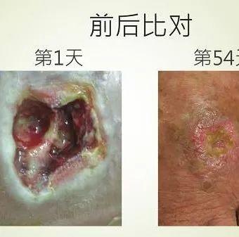 腳部傷口案例（簡體版）-七不姜 生姜養生網-明德CSA生態姜園&明安農業