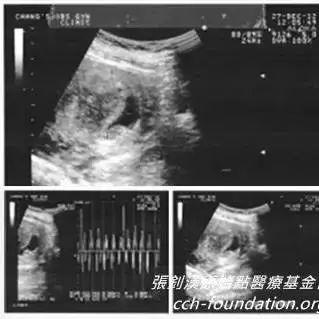 胎死腹中案例（臺灣）（簡體版）-七不姜 生姜養生網-明德CSA生態姜園&明安農業