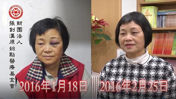 車禍頭部外傷出血案例（簡體版）-七不姜 生姜養生網-明德CSA生態姜園&明安農業