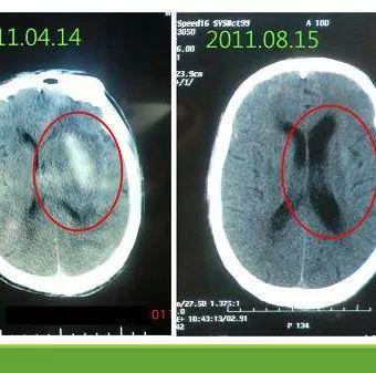 腦出血案例（鐘老先生）（簡體版）-七不姜 生姜養生網-明德CSA生態姜園&明安農業