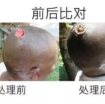 頭部潰爛案例（簡體版）-七不姜 生姜養生網-明德CSA生態姜園&明安農業