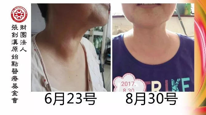 甲狀腺結節案例-七不姜 生姜養生網-明德CSA生態姜園&明安農業