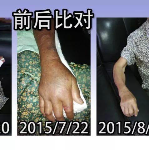 手骨折案例（老人）（簡體版）-七不姜 生姜養生網-明德CSA生態姜園&明安農業