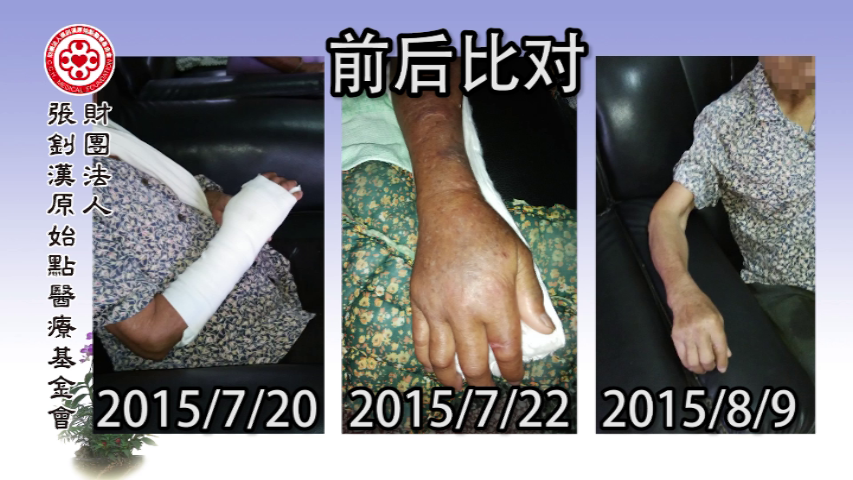手骨折案例（老人）（簡體版）
