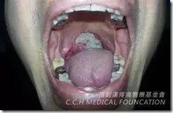 扁桃腺癌案例-七不姜 生姜養生網-明德CSA生態姜園&明安農業