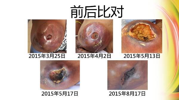 82歲婆婆乳癌案例（簡體版）-七不姜 生姜養生網-明德CSA生態姜園&明安農業