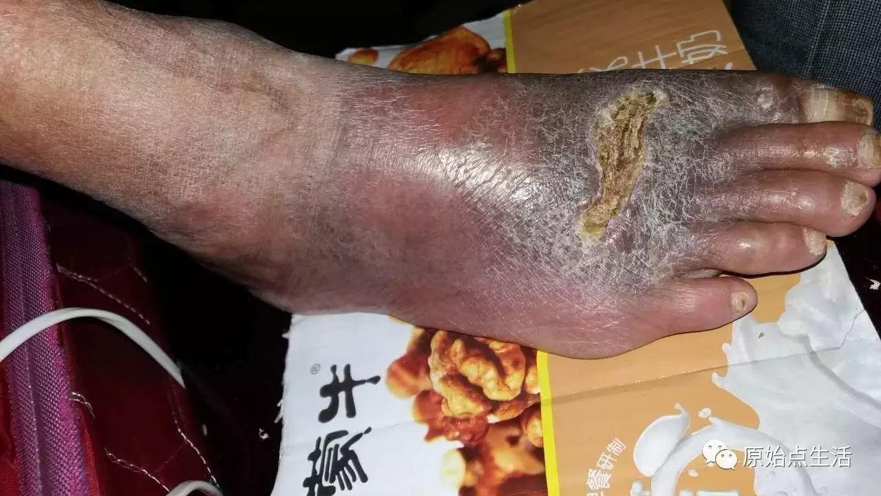 用原始點調理毒蛇咬傷成功案例-七不姜 生姜養生網-明德CSA生態姜園&明安農業