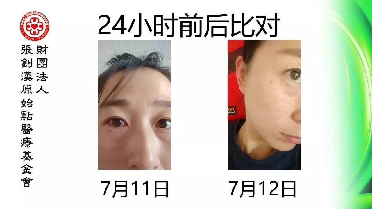 結膜炎案例-七不姜 生姜養生網-明德CSA生態姜園&明安農業