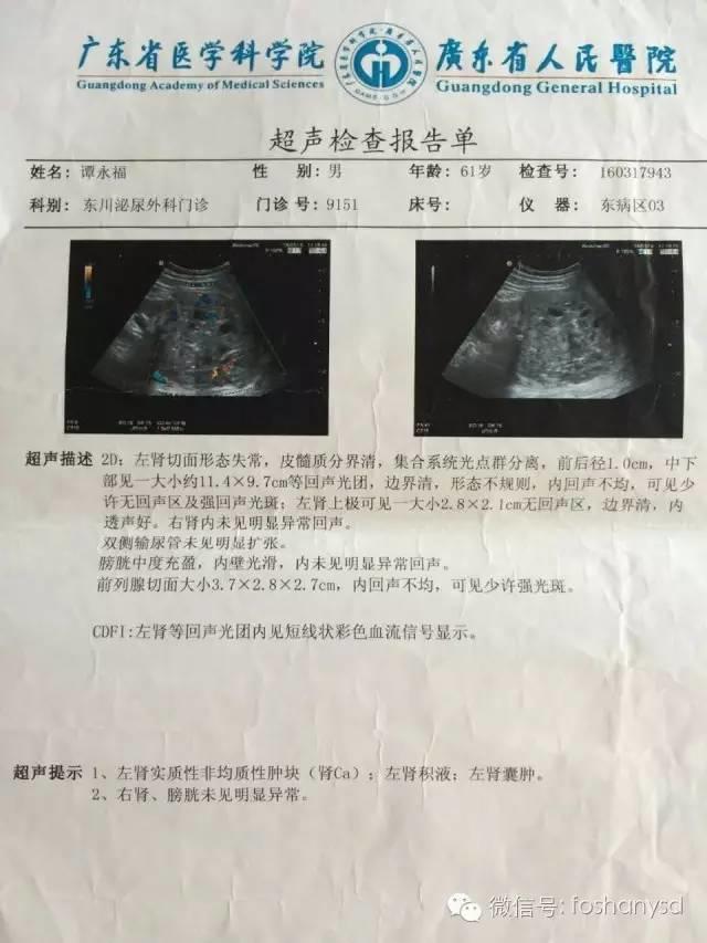 樂觀積極的心態成就自己的健康，原始點調理腎癌中期，三個月恢復健康