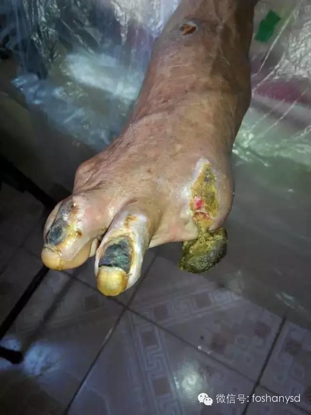 中國大陸“黑腳阿媽”感恩原始點讓她免遭截肢之苦