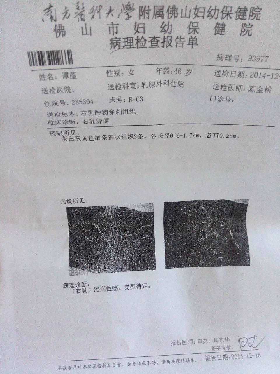 原始點調理乳腺癌三個月基本康復
