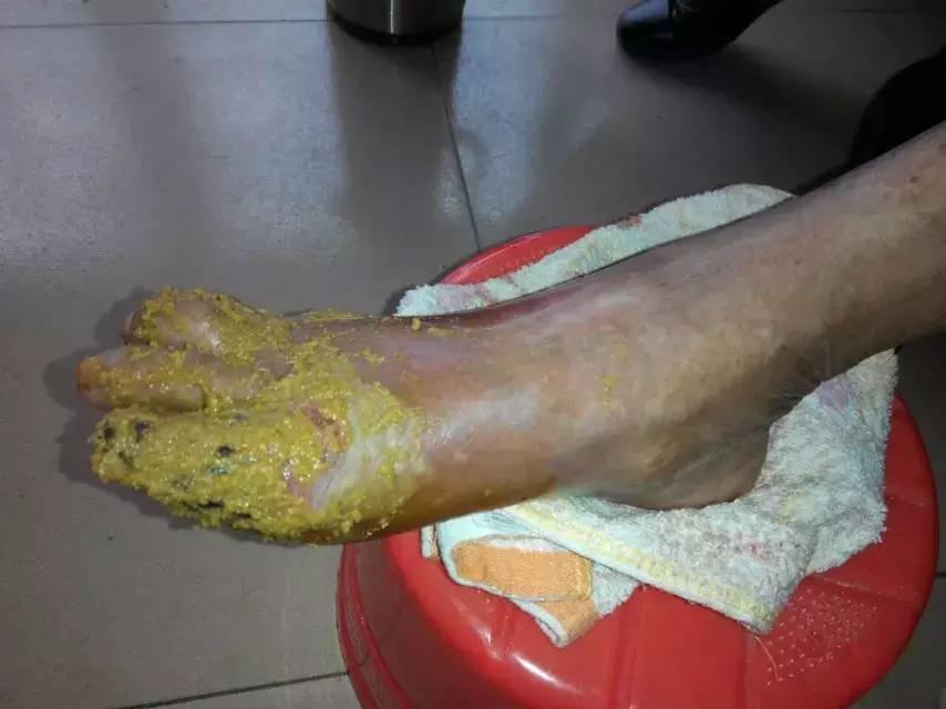 中國大陸“黑腳阿媽”感恩原始點讓她免遭截肢之苦