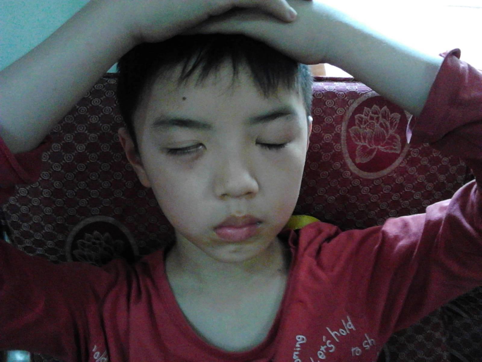 用原始點理療病毒性腦炎后遺癥三個月好了一大半
