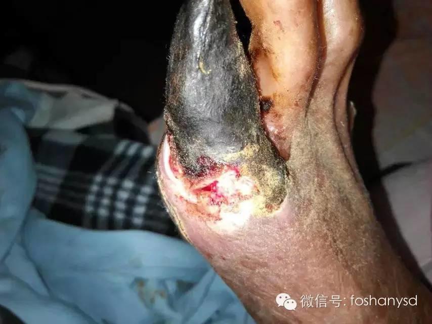 中國大陸“黑腳阿媽”感恩原始點讓她免遭截肢之苦