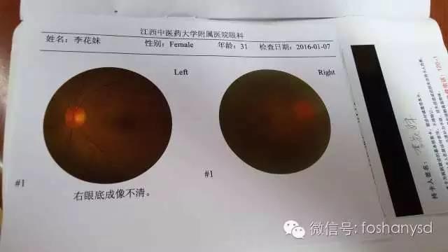 因眼睛問題用原始點調理身體一個多月，意外減肥20斤
