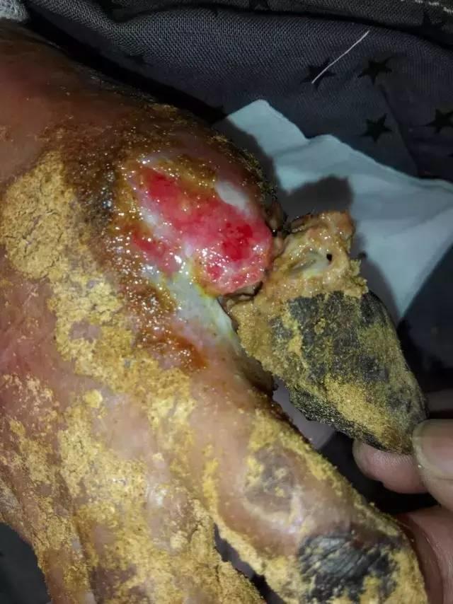 中國大陸“黑腳阿媽”感恩原始點讓她免遭截肢之苦