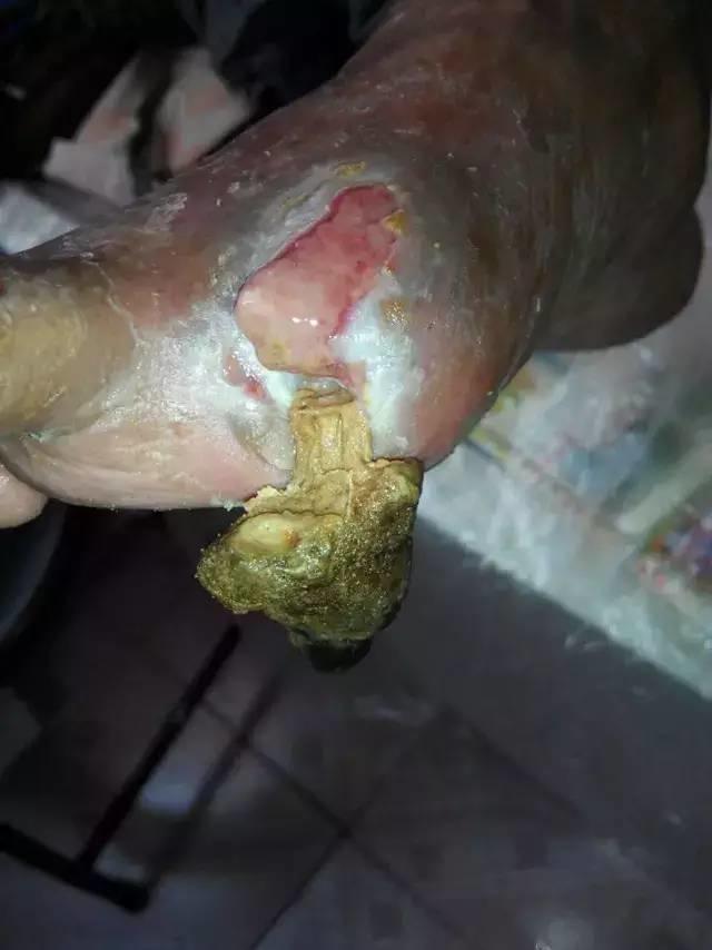 中國大陸“黑腳阿媽”感恩原始點讓她免遭截肢之苦